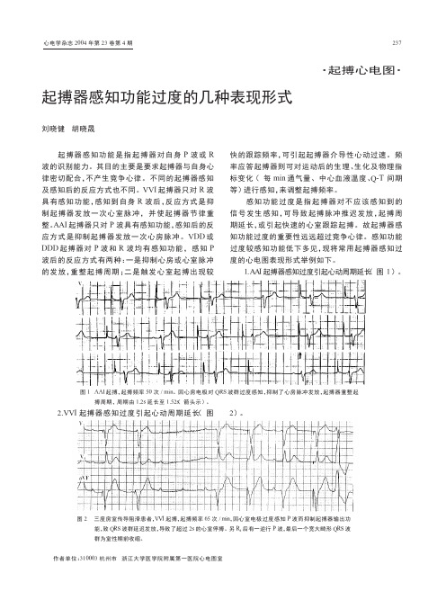 起搏器感知功能过度的几种表现形式[1]