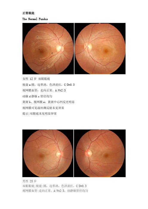 正常眼底及常见异常眼底图分析(眼底照相)