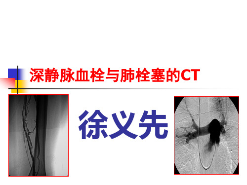 肺栓塞的CT