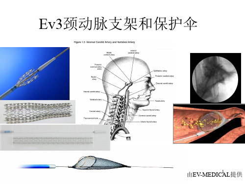 (参考课件)颈动脉支架和保护伞