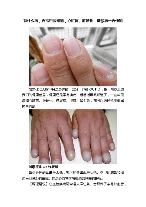 有什么病，看指甲就知道，心脏病、肝硬化、糖尿病一看便知