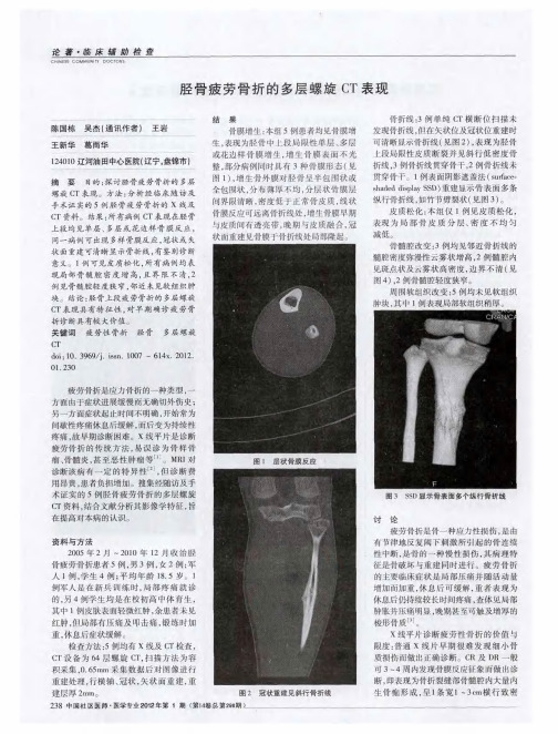 胫骨疲劳骨折的多层螺旋CT表现