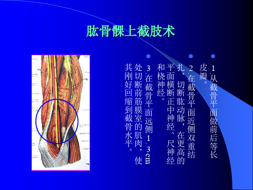 ——上肢截肢术