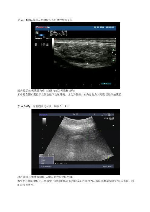 腹股沟疝的超声诊断【可编辑范本】