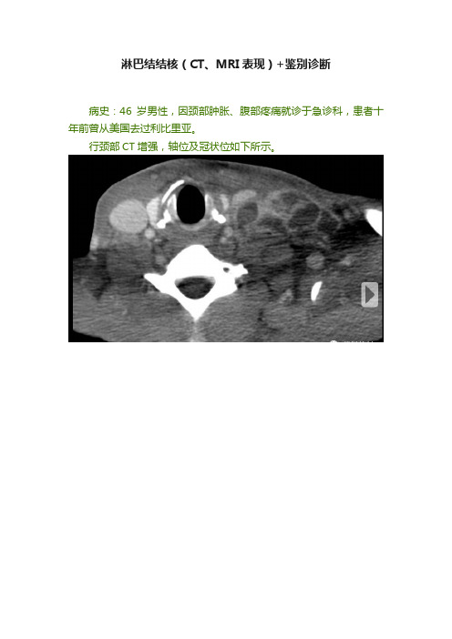 淋巴结结核（CT、MRI表现）+鉴别诊断