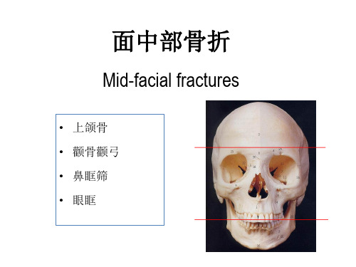 口腔颌面外科学：面中部骨折