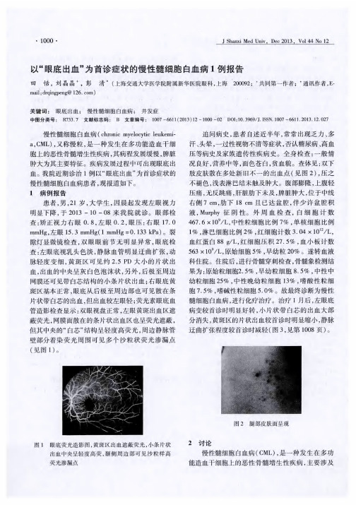 以“眼底出血”为首诊症状的慢性髓细胞白血病1例报告