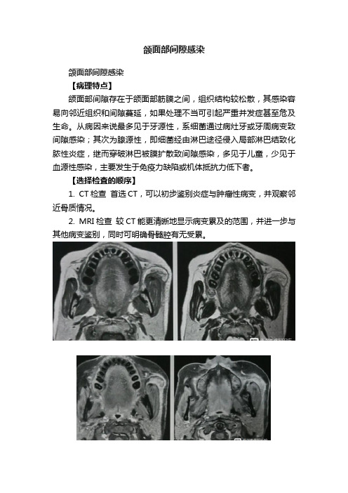 颌面部间隙感染