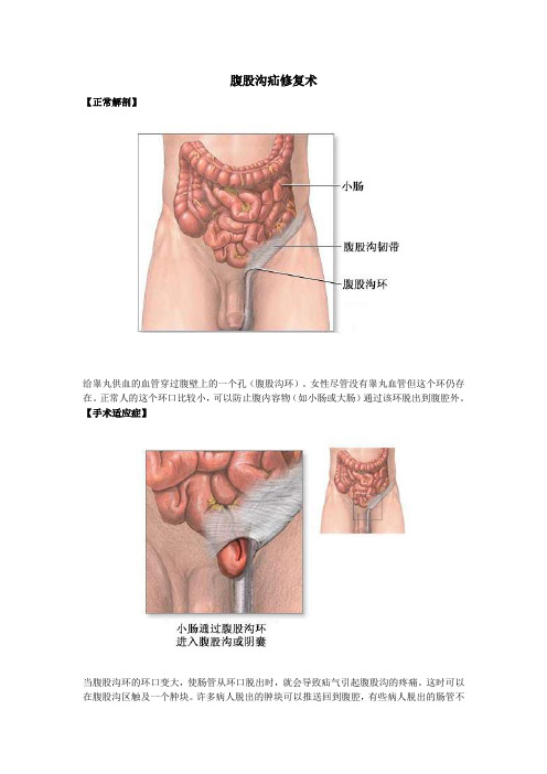 腹股沟疝修复术