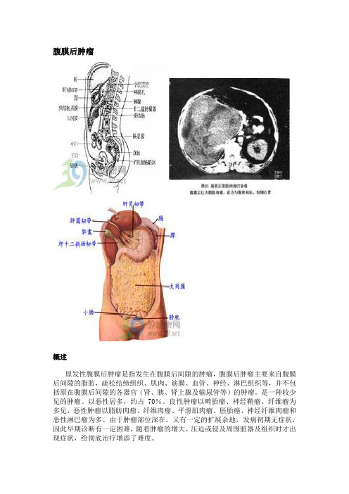 腹膜后肿瘤