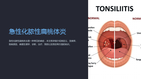 急性化脓性扁桃体炎