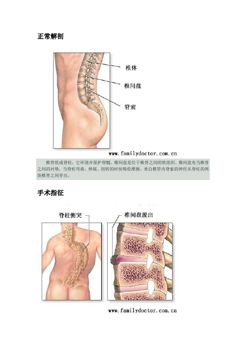 脊柱融合术