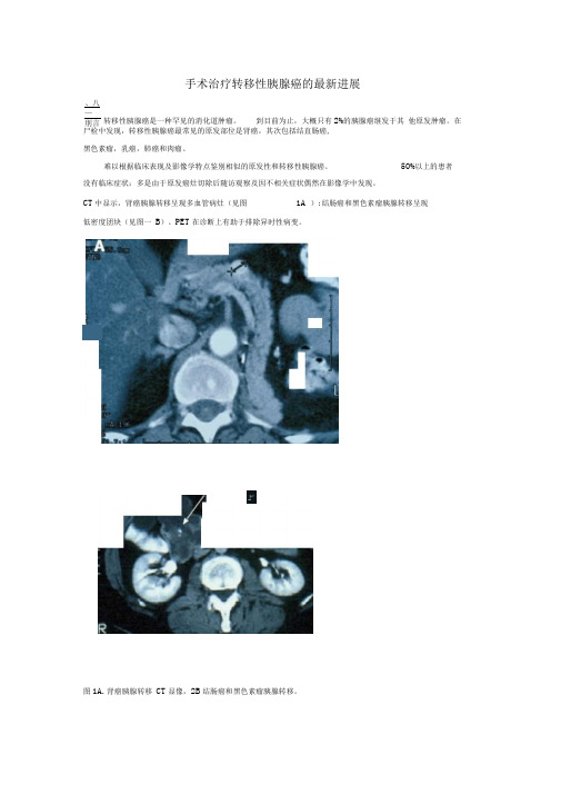 手术治疗转移性胰腺癌的最新进展