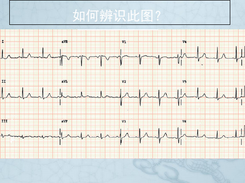 杏树林讲座正确识别心电图
