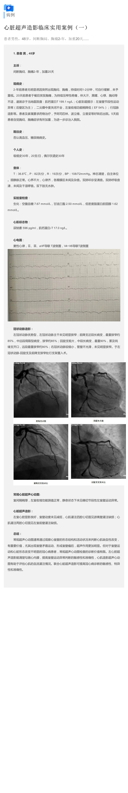 病例分析：心脏超声造影临床实用案例(一)