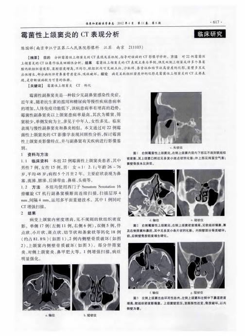 霉菌性上颌窦炎的CT表现分析