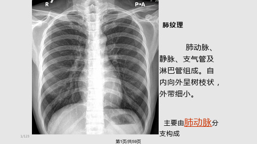 肺动脉栓塞影像诊断1PPT课件