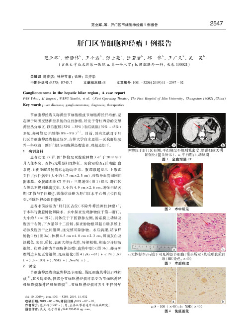 肝门区节细胞神经瘤1例报告 范业辉