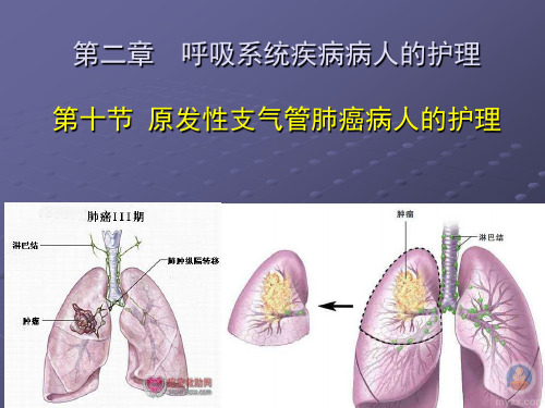 原发性支气管肺癌病人的护理-(2)ppt课件