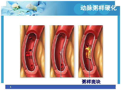 冠心病的护理课堂PPT