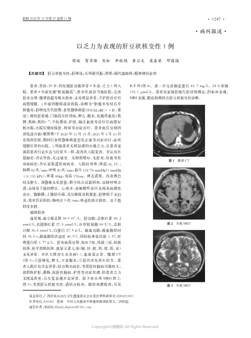 以乏力为表现的肝豆状核变性1例