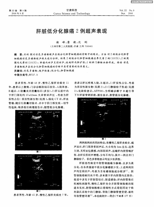 肝脏低分化腺癌2例超声表现