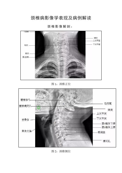 颈椎病影像学表现及病例解读