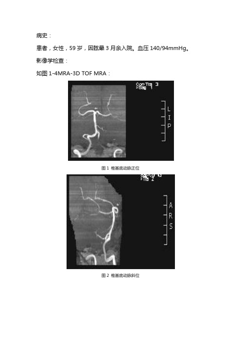 椎动脉闭塞MRA诊断及鉴别诊断