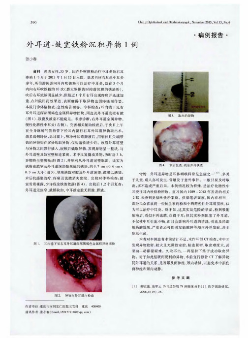 外耳道一鼓室铁粉沉积异物1例