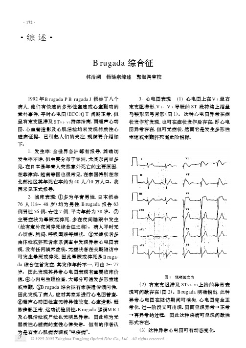 Brugada综合征