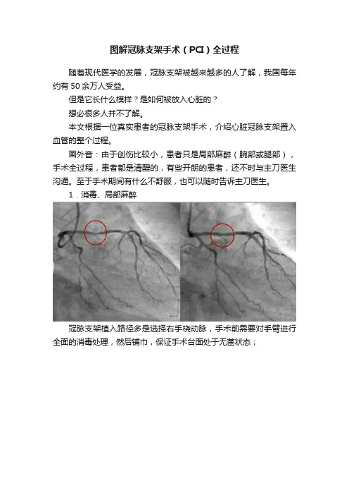 图解冠脉支架手术（PCI）全过程