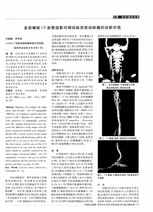 多层螺旋CT血管造影对颈动脉夹层动脉瘤的诊断价值