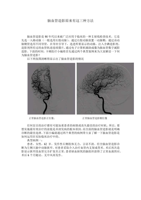 【实力科普】脑血管造影原来有这三种方法