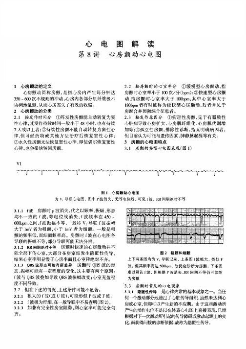 心房颤动心电图