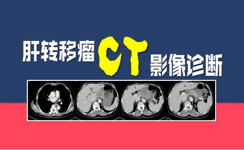 肝转移瘤CT影像诊断