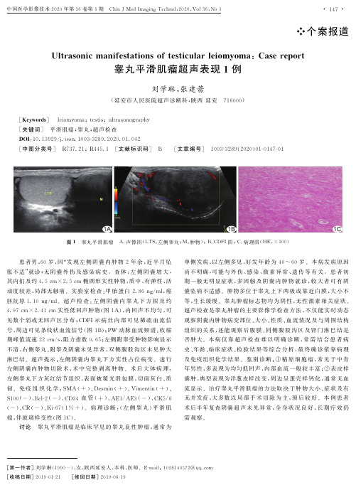 睾丸平滑肌瘤超声表现1例
