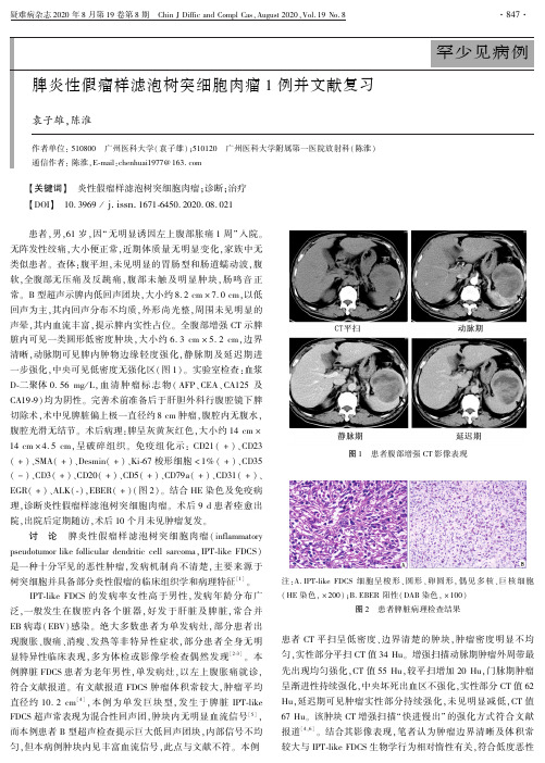 脾炎性假瘤样滤泡树突细胞肉瘤1例并文献复习