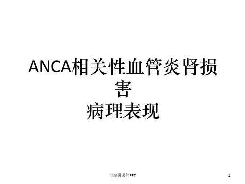 ANCA相关性血管炎肾损害病理表现ppt课件