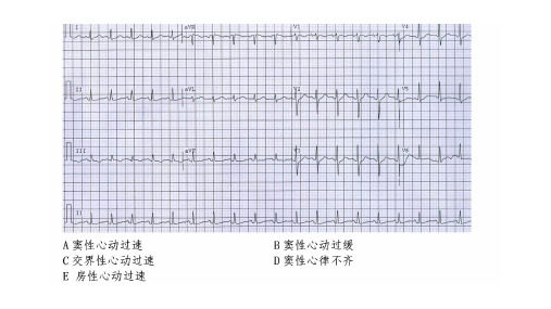 心电图练习题(带图有答案)