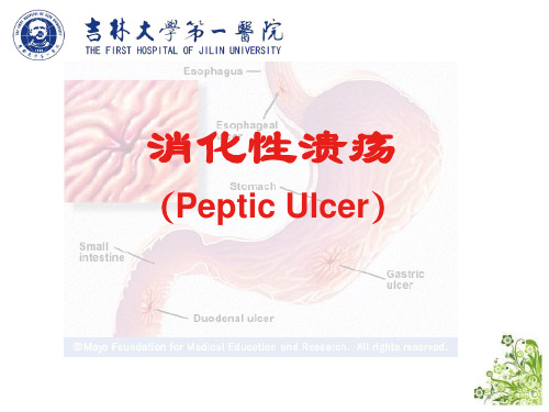 消化性溃疡 内科学