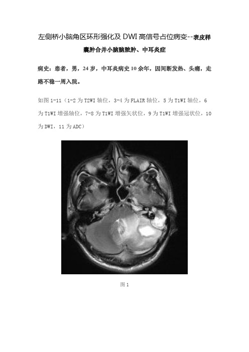 左侧桥小脑角区环形强化及DWI高信号占位病变--表皮样囊肿合并小脑脑脓肿、中耳炎症