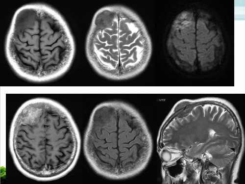 颅内淋巴瘤CTMR诊断与鉴别PPT课件