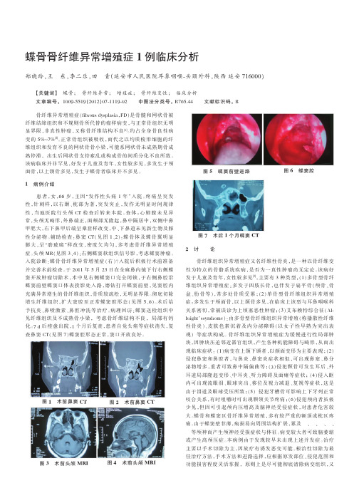 蝶骨骨纤维异常增殖症1例临床