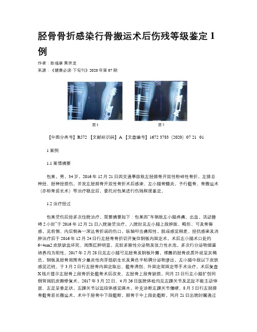 胫骨骨折感染行骨搬运术后伤残等级鉴定1例