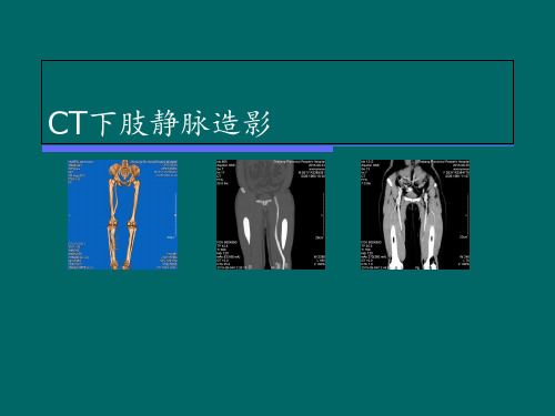 CT下肢静脉造影【放射科】 ppt课件