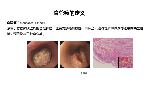 食管癌的定义(图解)