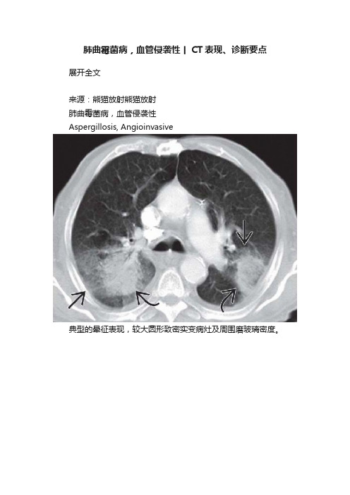 肺曲霉菌病，血管侵袭性丨CT表现、诊断要点