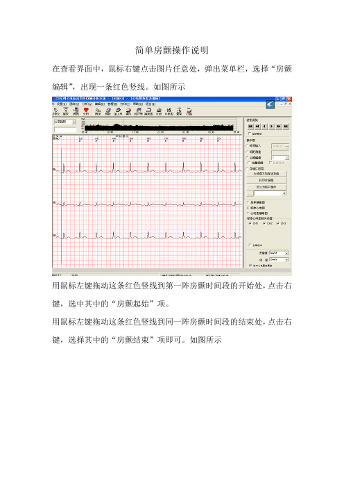 房颤分析方法