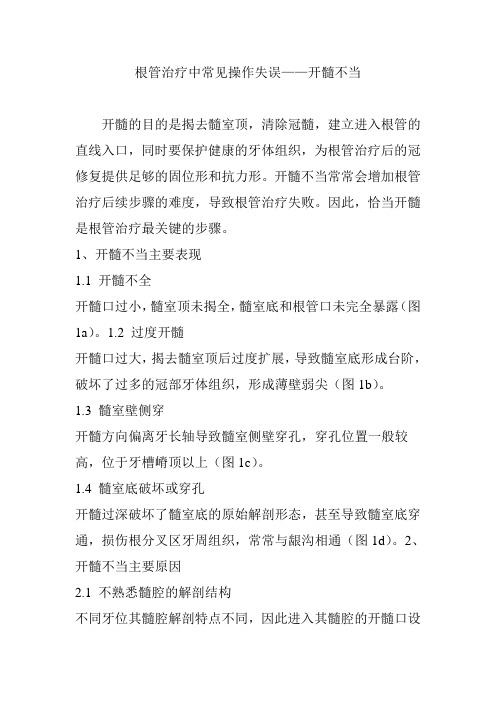 根管治疗中常见操作失误开髓不当