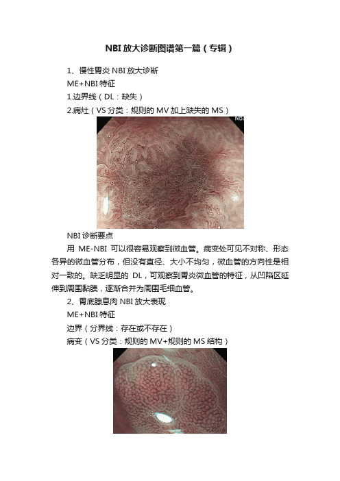 NBI放大诊断图谱第一篇（专辑）